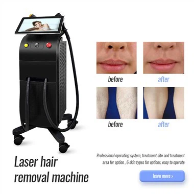 Titanijumsko lasersko uklanjanje dlačica