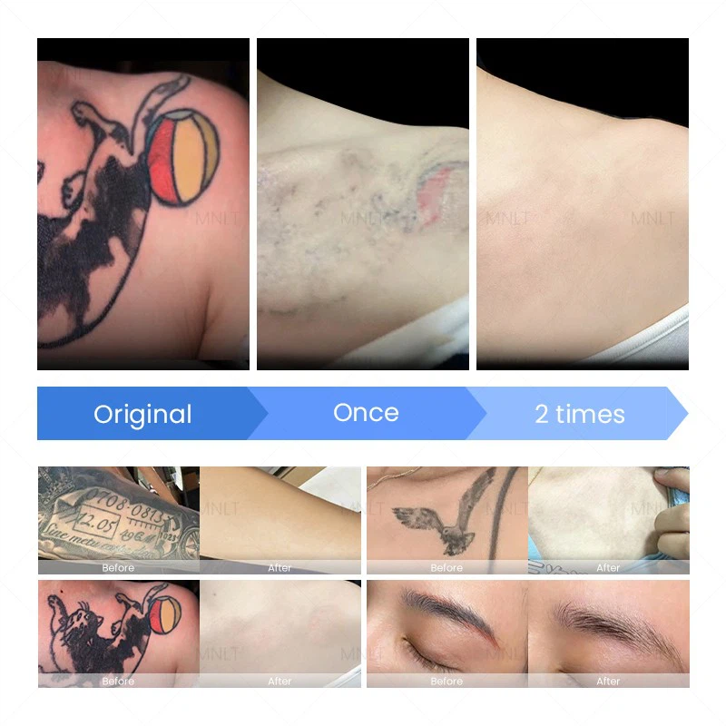 Best Picosecond Laser Machine For All Skin