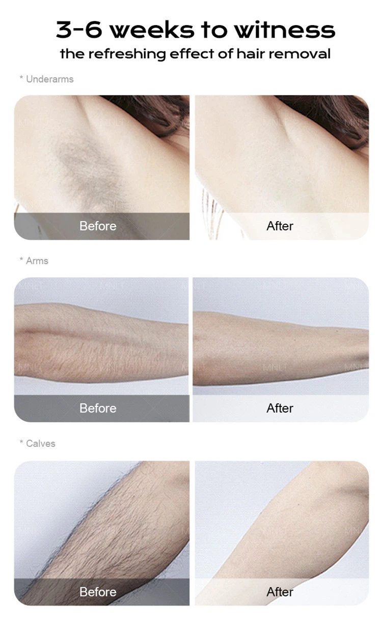 Professional-Grade Diode Laser Hair Removal Machine